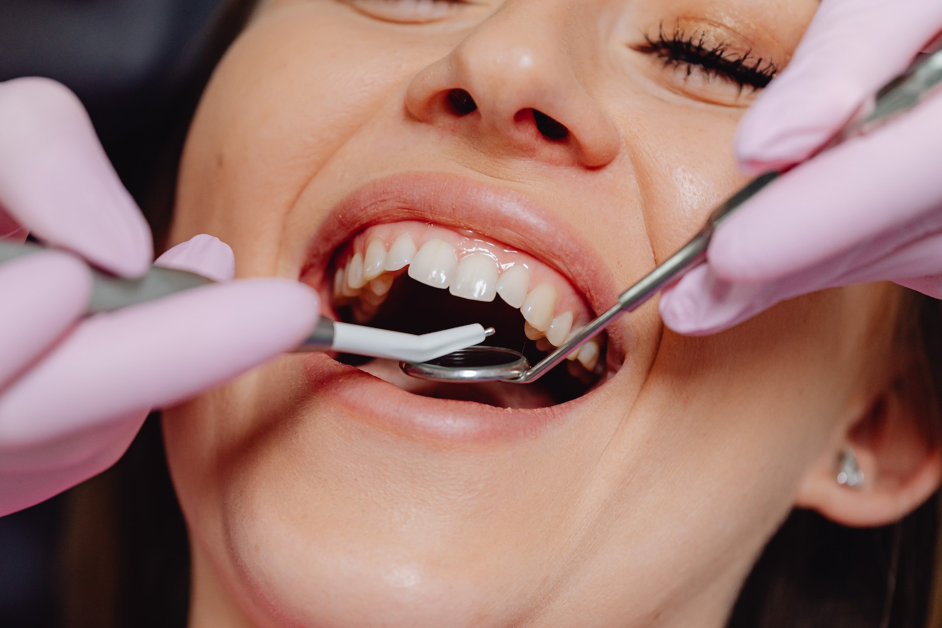 La gengivite è un processo infiammatorio che riguarda le gengive: l'acqua salata può dare sollievo nell'attesa di una visita dal dentista.