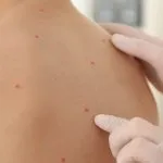 Il contagio della varicella: quali sono le cause e cosa fare